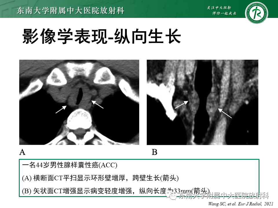 影像PPT - 【PPT】气管腺样囊性癌-15