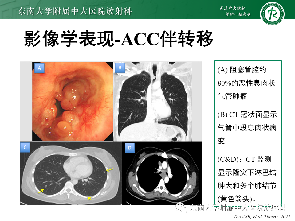 影像PPT - 【PPT】气管腺样囊性癌-16
