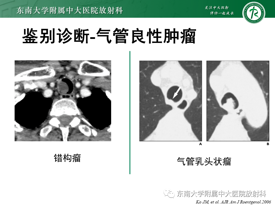 影像PPT - 【PPT】气管腺样囊性癌-21