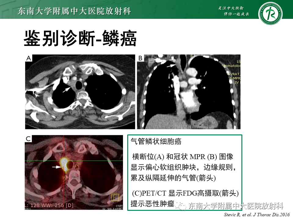 影像PPT - 【PPT】气管腺样囊性癌-25