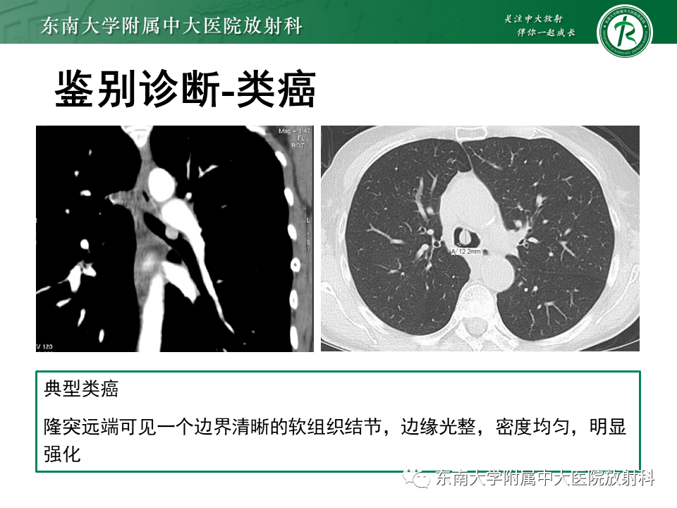 影像PPT - 【PPT】气管腺样囊性癌-27