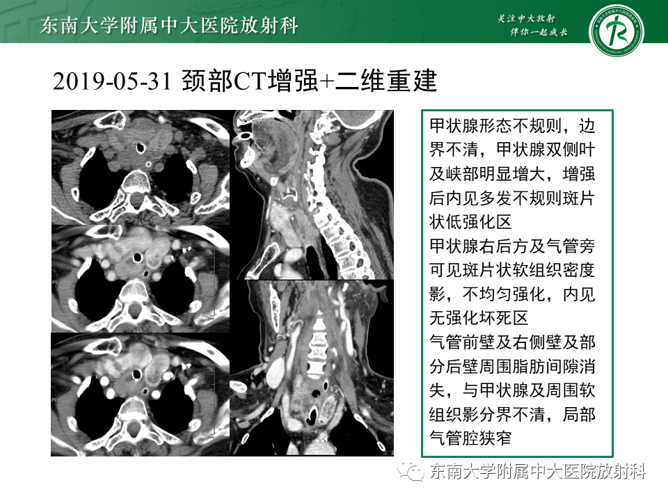影像PPT - 【PPT】气管腺样囊性癌-29