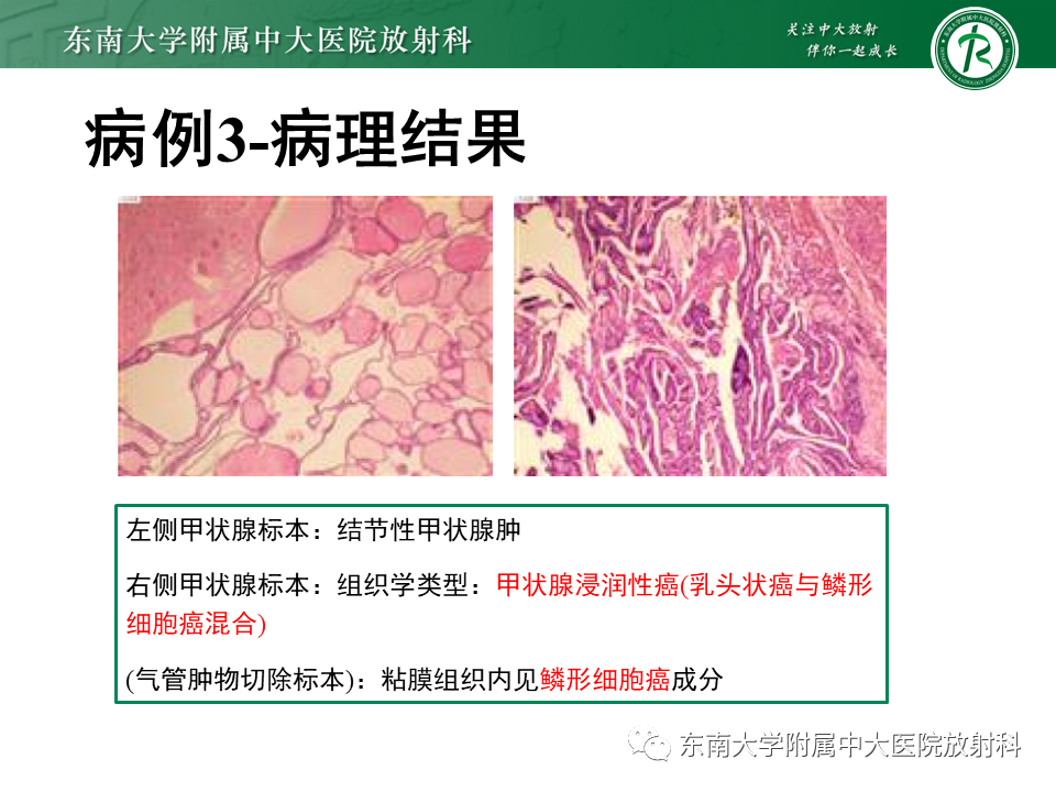 影像PPT - 【PPT】气管腺样囊性癌-30