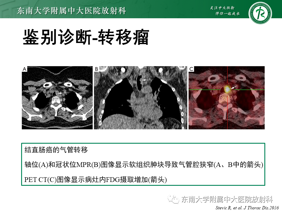 影像PPT - 【PPT】气管腺样囊性癌-32