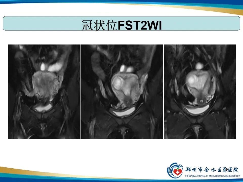 影像PPT - 【PPT】异位妊娠影像学诊断-6