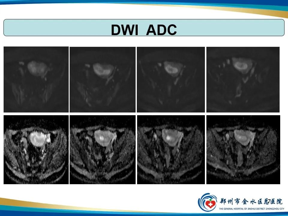 影像PPT - 【PPT】异位妊娠影像学诊断-7