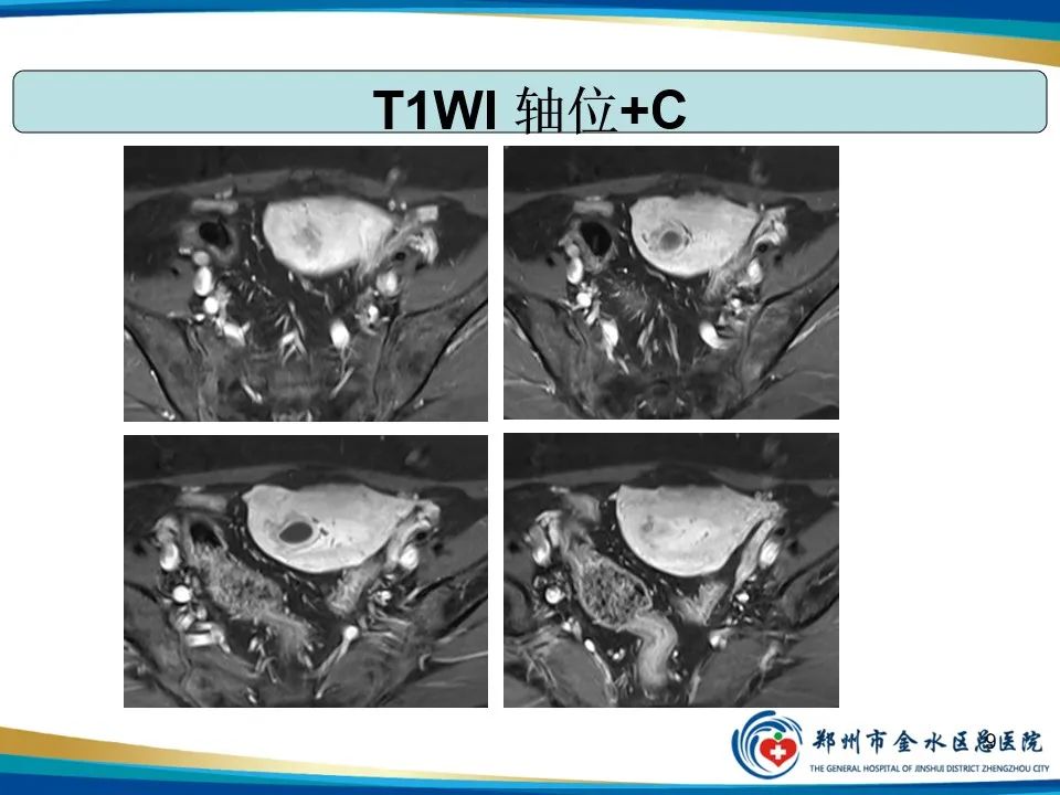 影像PPT - 【PPT】异位妊娠影像学诊断-9