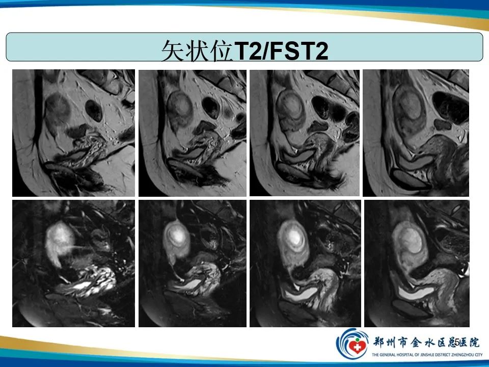 影像PPT - 【PPT】异位妊娠影像学诊断-5