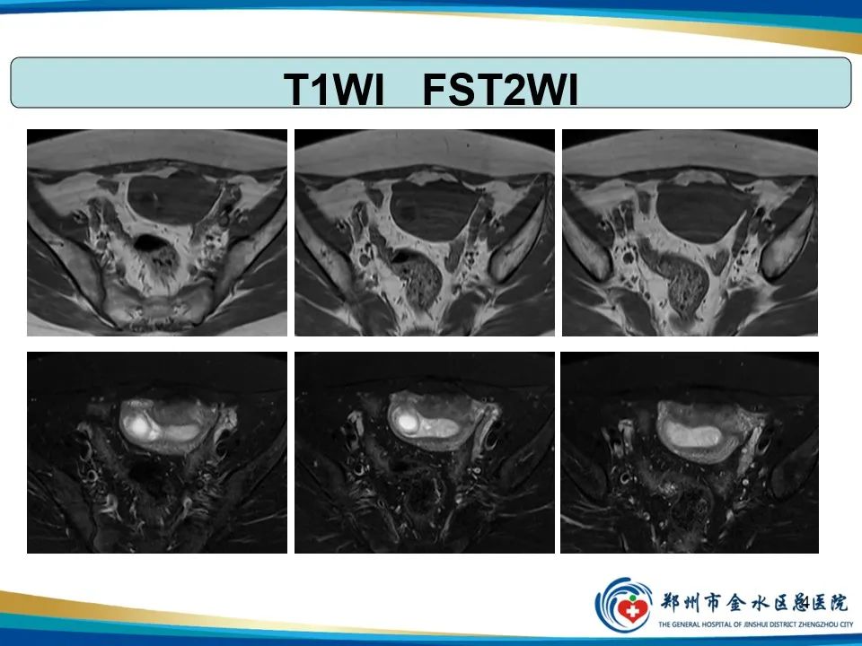 影像PPT - 【PPT】异位妊娠影像学诊断-4