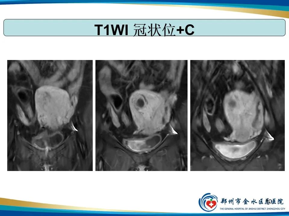 影像PPT - 【PPT】异位妊娠影像学诊断-10