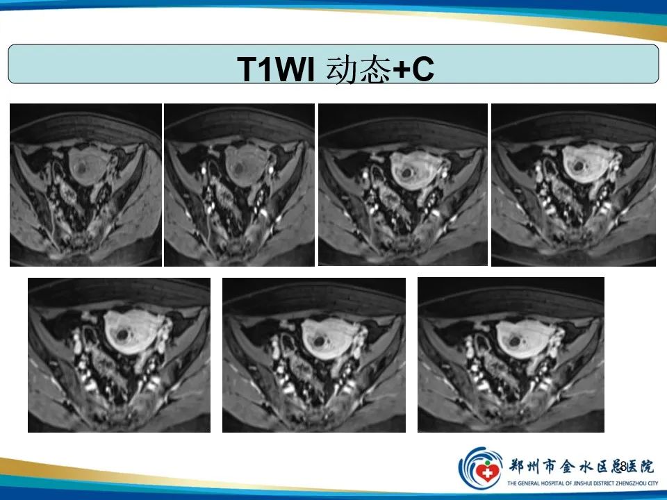 影像PPT - 【PPT】异位妊娠影像学诊断-8