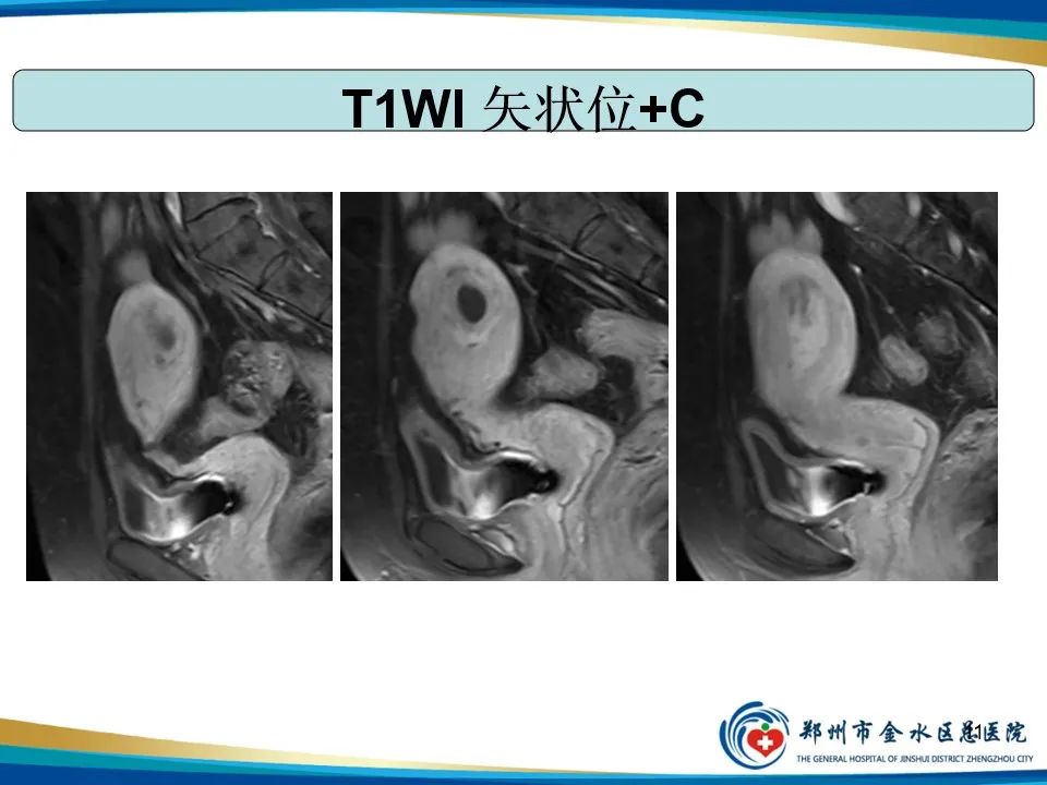 影像PPT - 【PPT】异位妊娠影像学诊断-11
