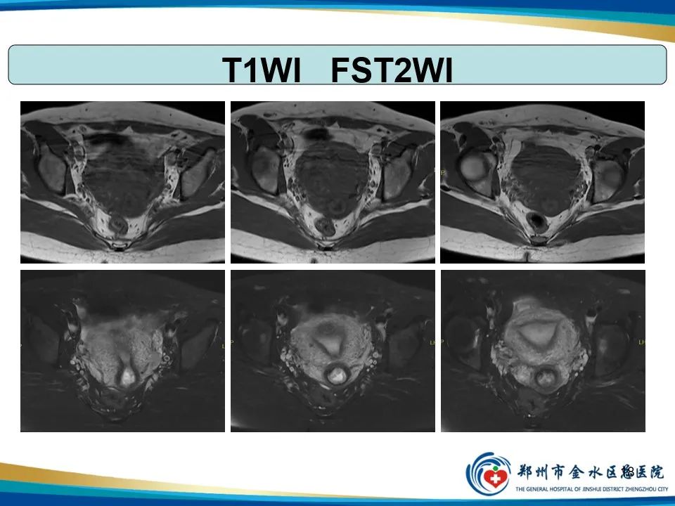 影像PPT - 【PPT】异位妊娠影像学诊断-18