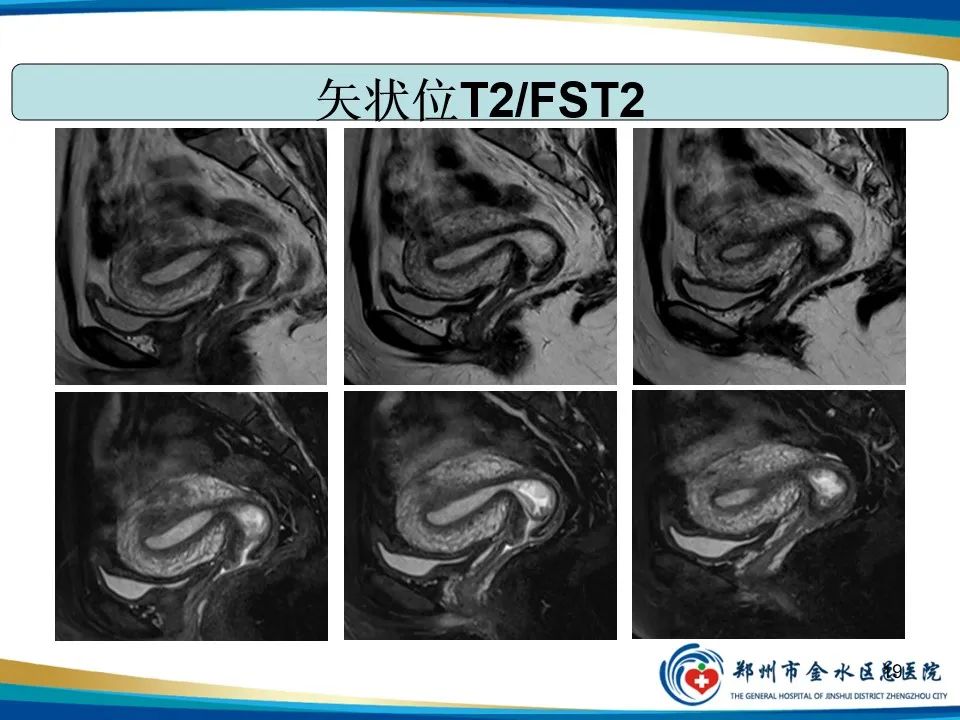影像PPT - 【PPT】异位妊娠影像学诊断-19