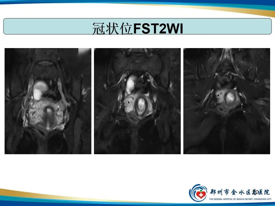 影像PPT - 【PPT】异位妊娠影像学诊断-20