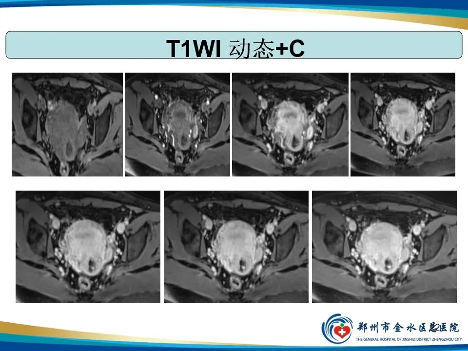 影像PPT - 【PPT】异位妊娠影像学诊断-22