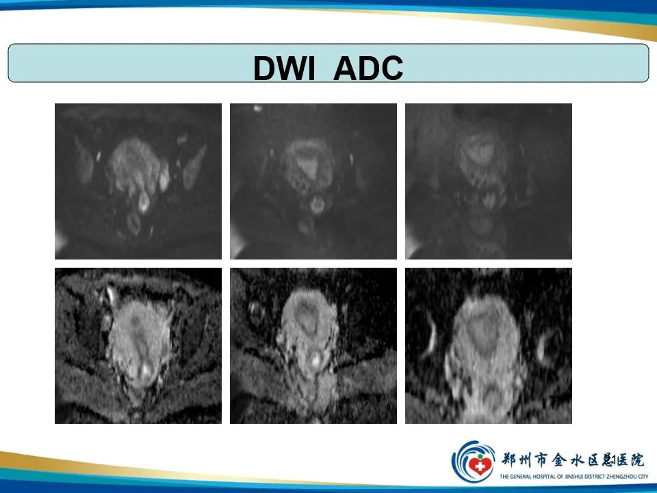 影像PPT - 【PPT】异位妊娠影像学诊断-21