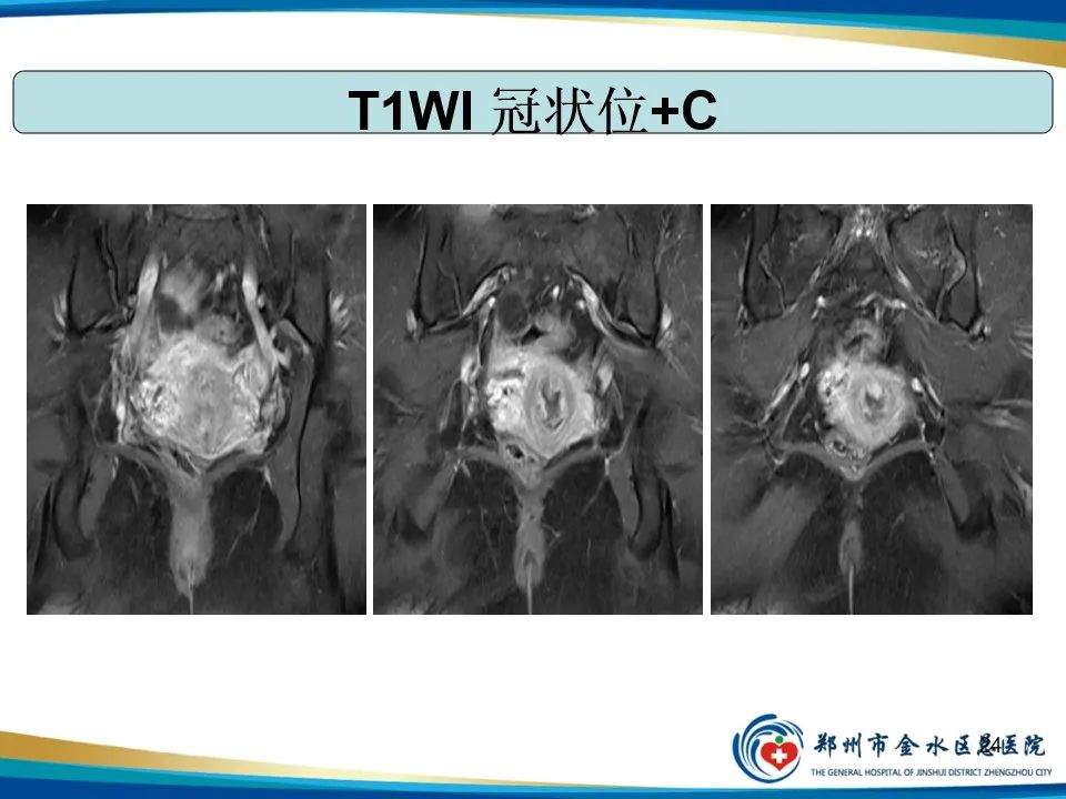 影像PPT - 【PPT】异位妊娠影像学诊断-24
