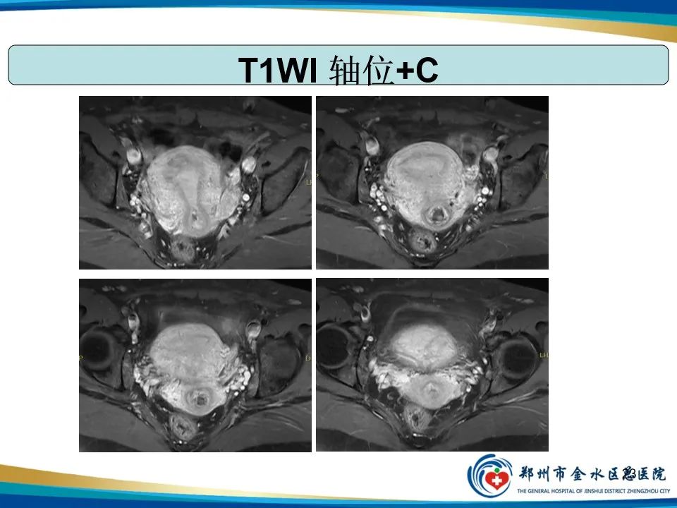 影像PPT - 【PPT】异位妊娠影像学诊断-23