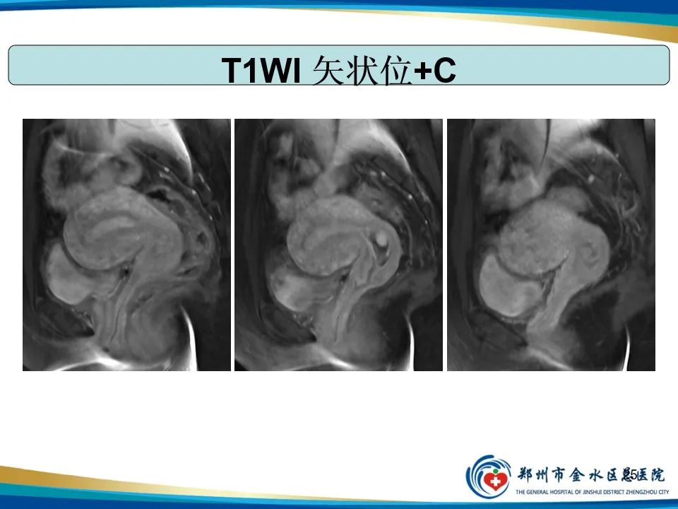 影像PPT - 【PPT】异位妊娠影像学诊断-25