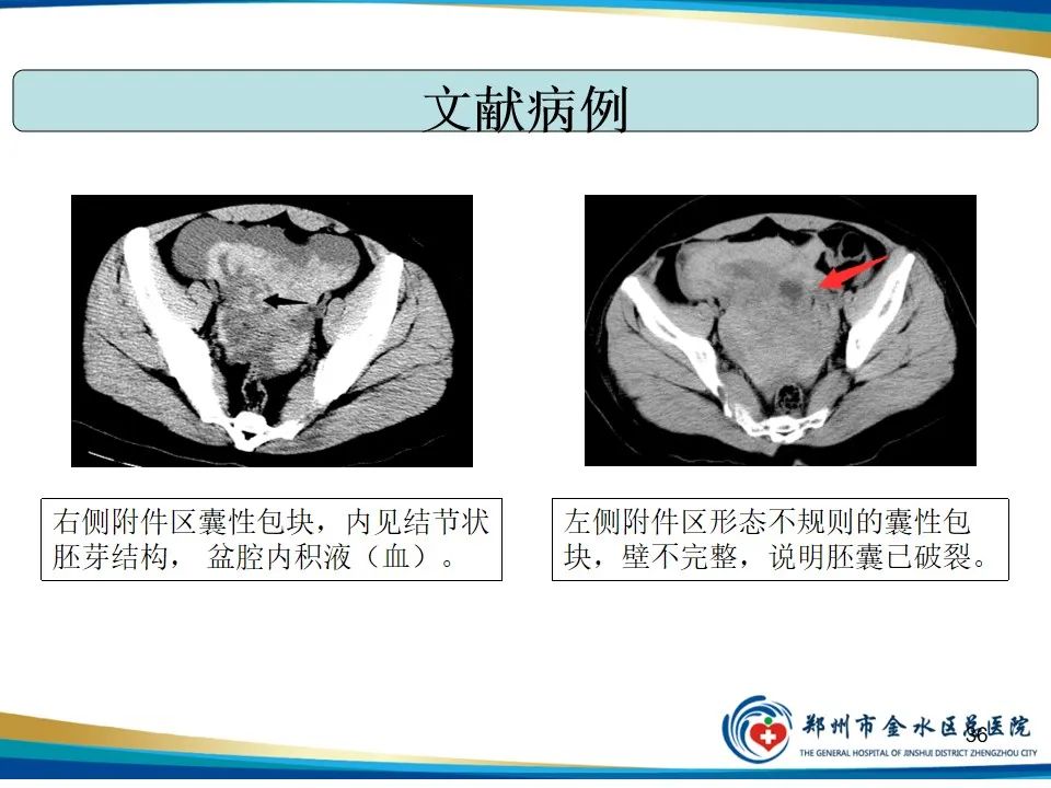 影像PPT - 【PPT】异位妊娠影像学诊断-36
