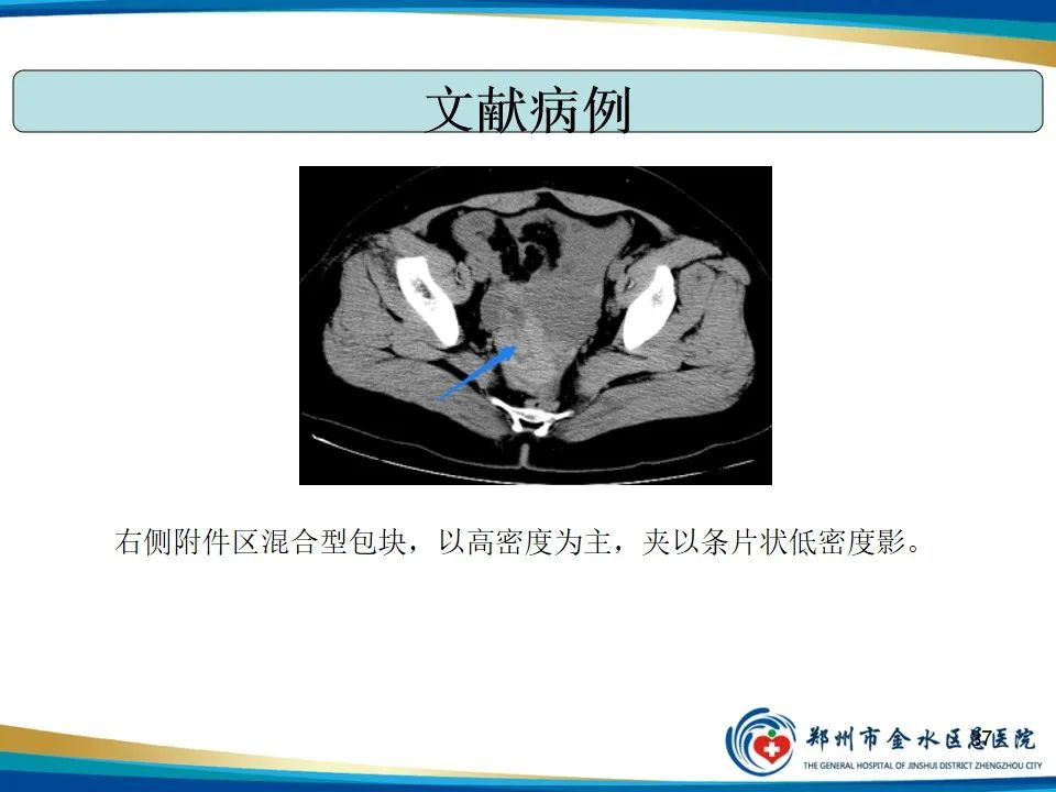 影像PPT - 【PPT】异位妊娠影像学诊断-37