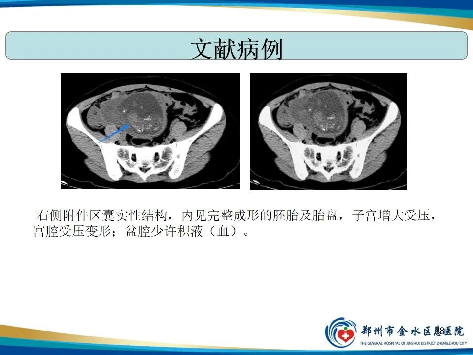 影像PPT - 【PPT】异位妊娠影像学诊断-38