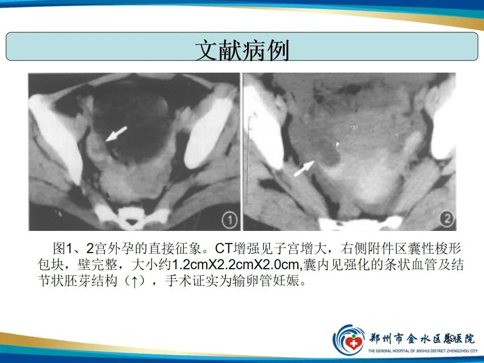 影像PPT - 【PPT】异位妊娠影像学诊断-39