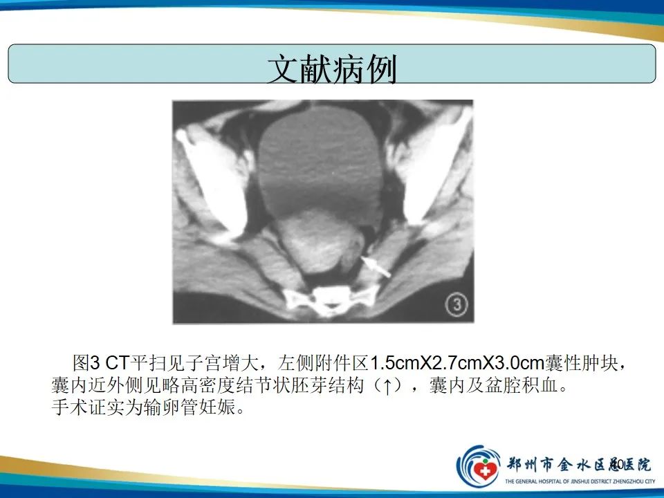 影像PPT - 【PPT】异位妊娠影像学诊断-40