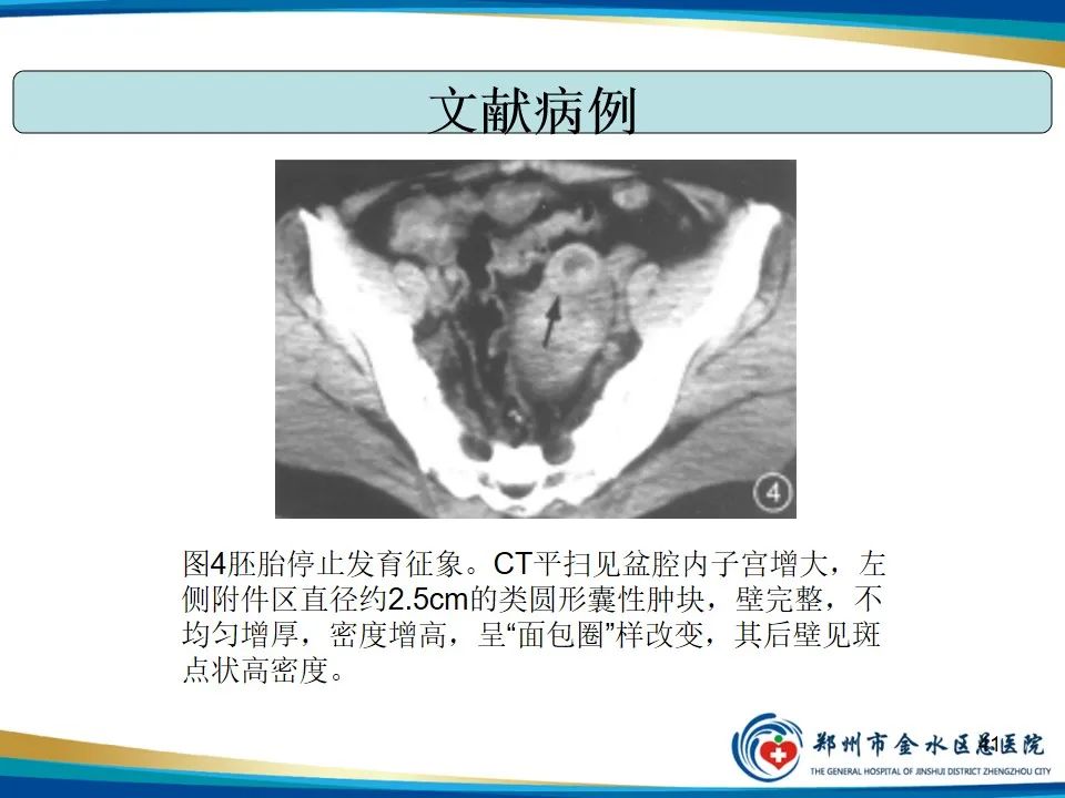 影像PPT - 【PPT】异位妊娠影像学诊断-41