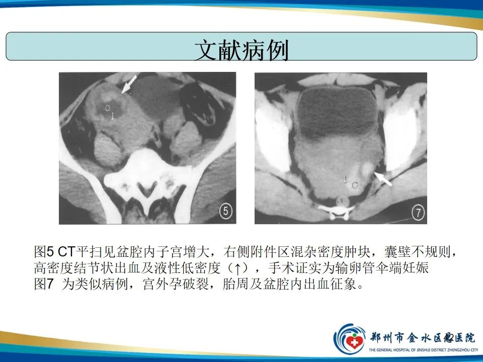 影像PPT - 【PPT】异位妊娠影像学诊断-42