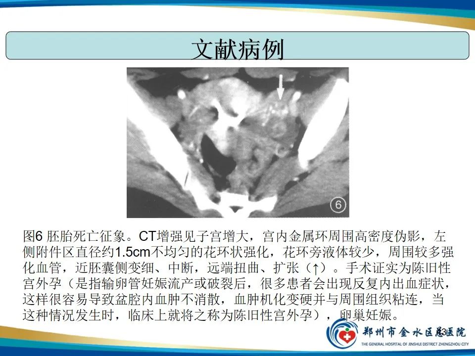 影像PPT - 【PPT】异位妊娠影像学诊断-43