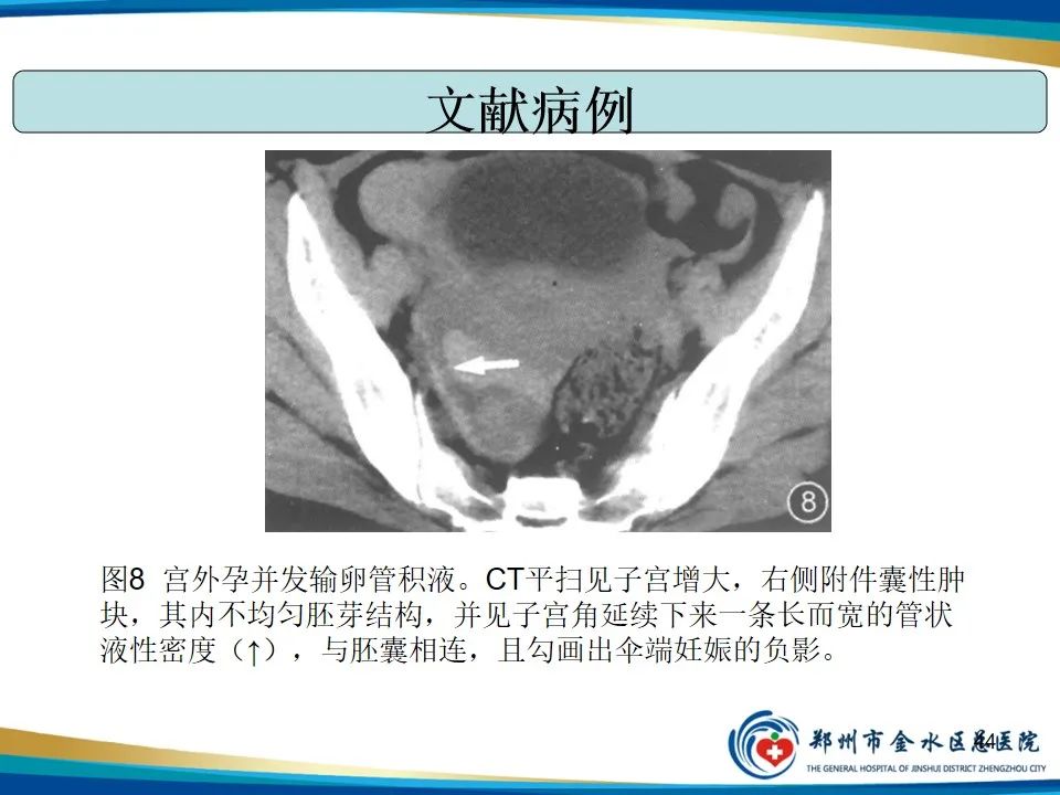 影像PPT - 【PPT】异位妊娠影像学诊断-44