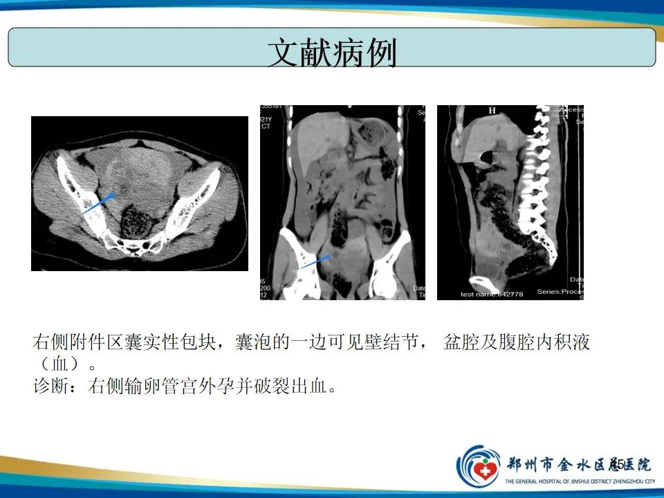 影像PPT - 【PPT】异位妊娠影像学诊断-45