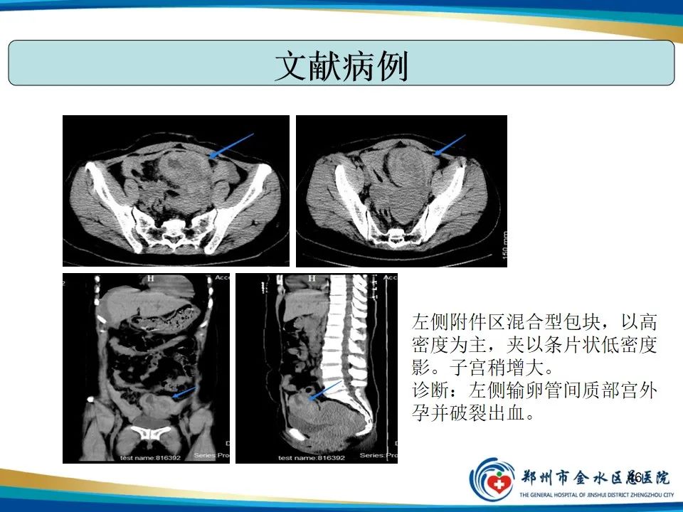 影像PPT - 【PPT】异位妊娠影像学诊断-46