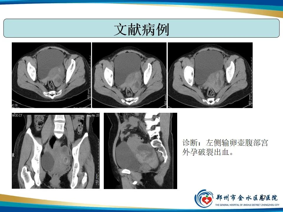 影像PPT - 【PPT】异位妊娠影像学诊断-47