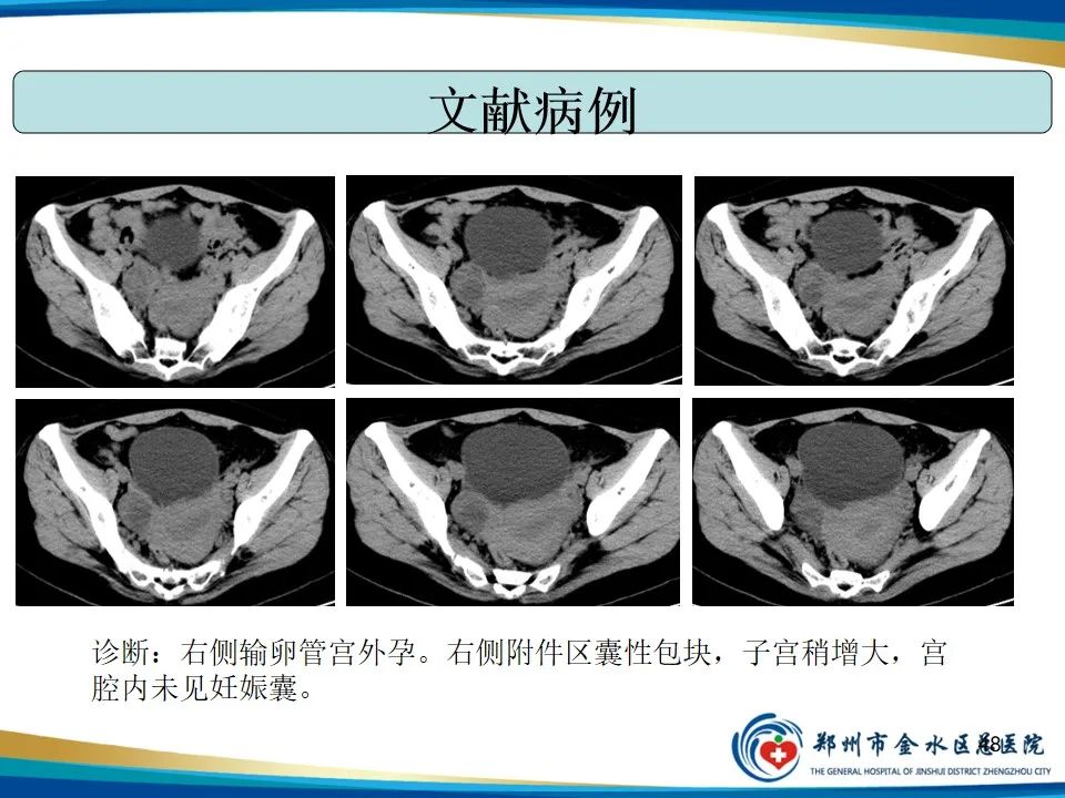 影像PPT - 【PPT】异位妊娠影像学诊断-48