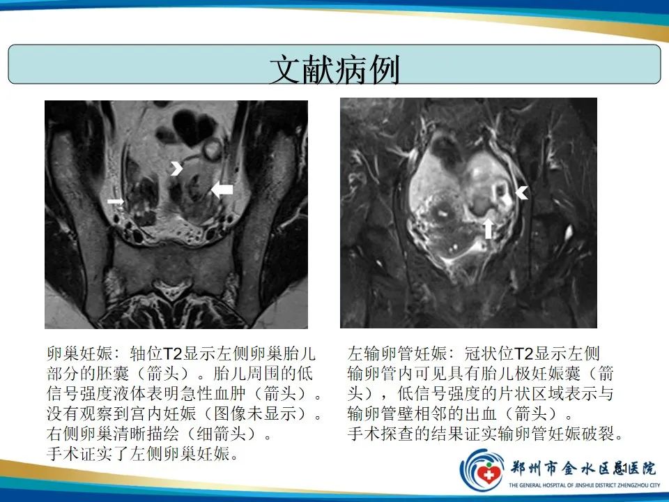 影像PPT - 【PPT】异位妊娠影像学诊断-51
