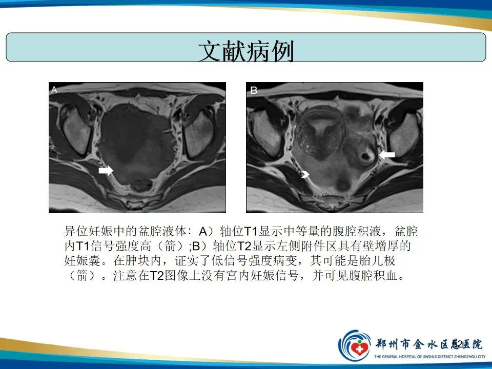 影像PPT - 【PPT】异位妊娠影像学诊断-52