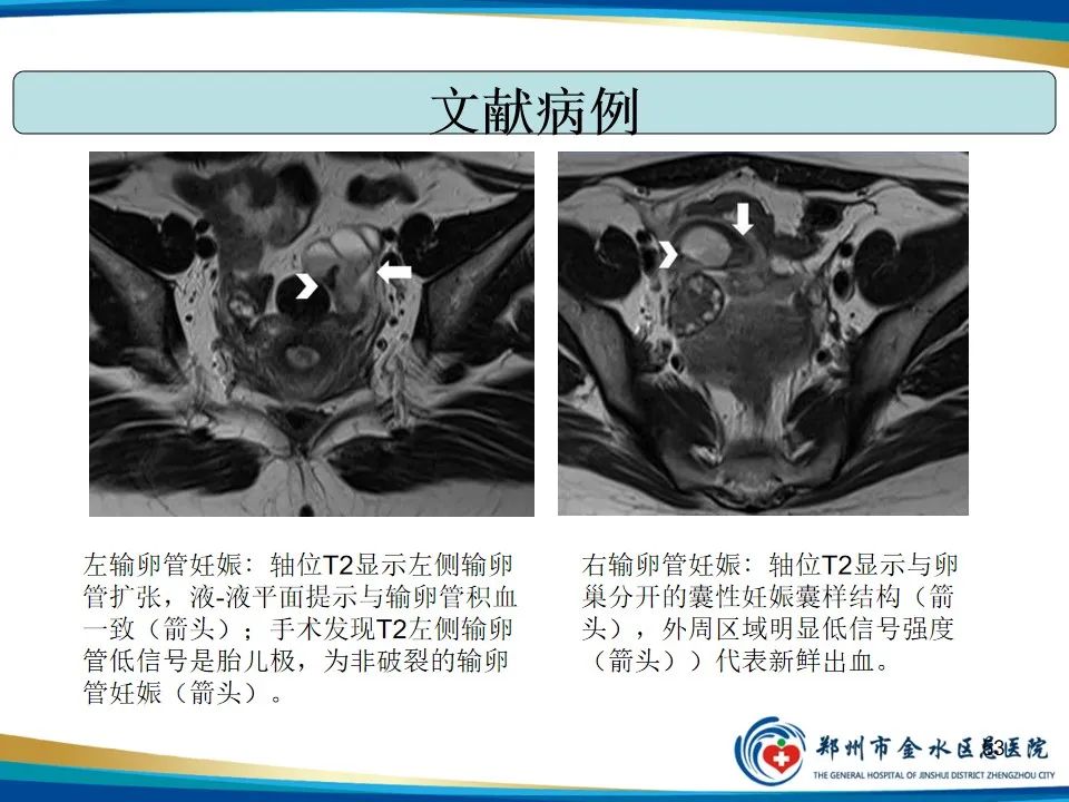 影像PPT - 【PPT】异位妊娠影像学诊断-53