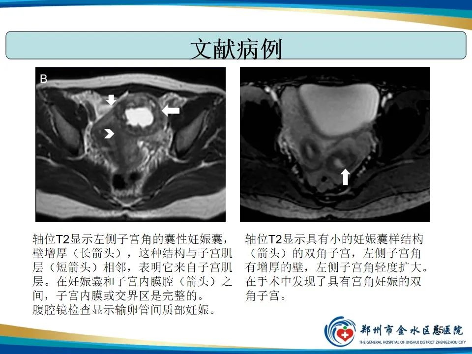 影像PPT - 【PPT】异位妊娠影像学诊断-55