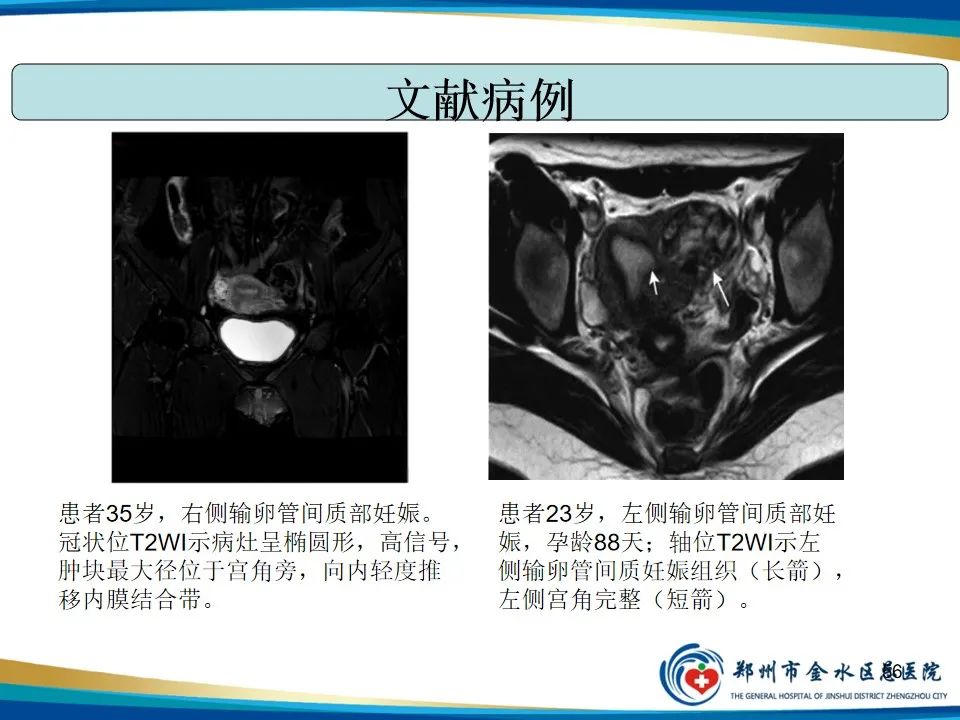 影像PPT - 【PPT】异位妊娠影像学诊断-56