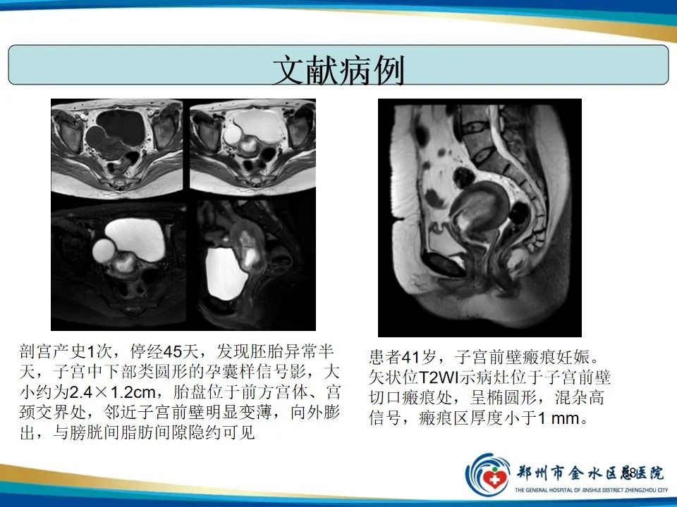 影像PPT - 【PPT】异位妊娠影像学诊断-58