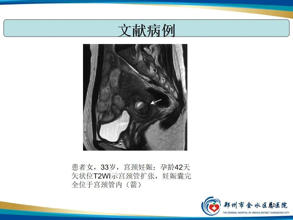影像PPT - 【PPT】异位妊娠影像学诊断-61