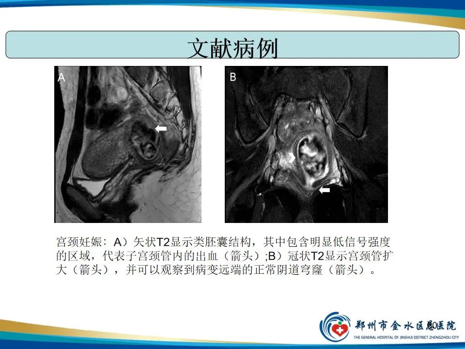 影像PPT - 【PPT】异位妊娠影像学诊断-60