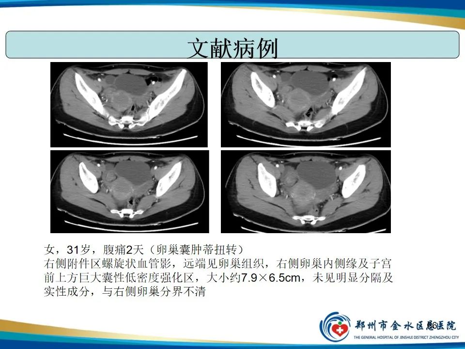 影像PPT - 【PPT】异位妊娠影像学诊断-66
