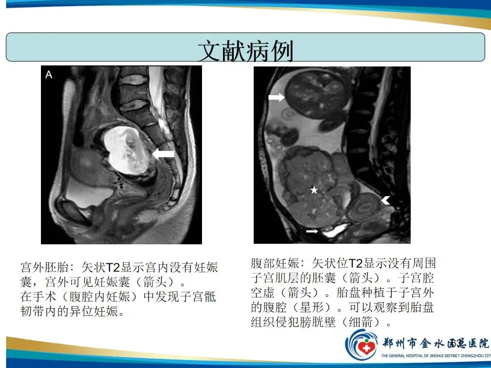 影像PPT - 【PPT】异位妊娠影像学诊断-63