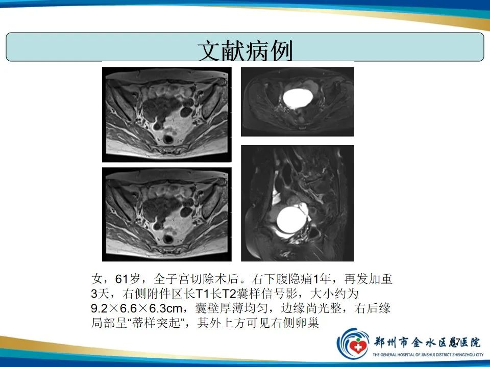 影像PPT - 【PPT】异位妊娠影像学诊断-67