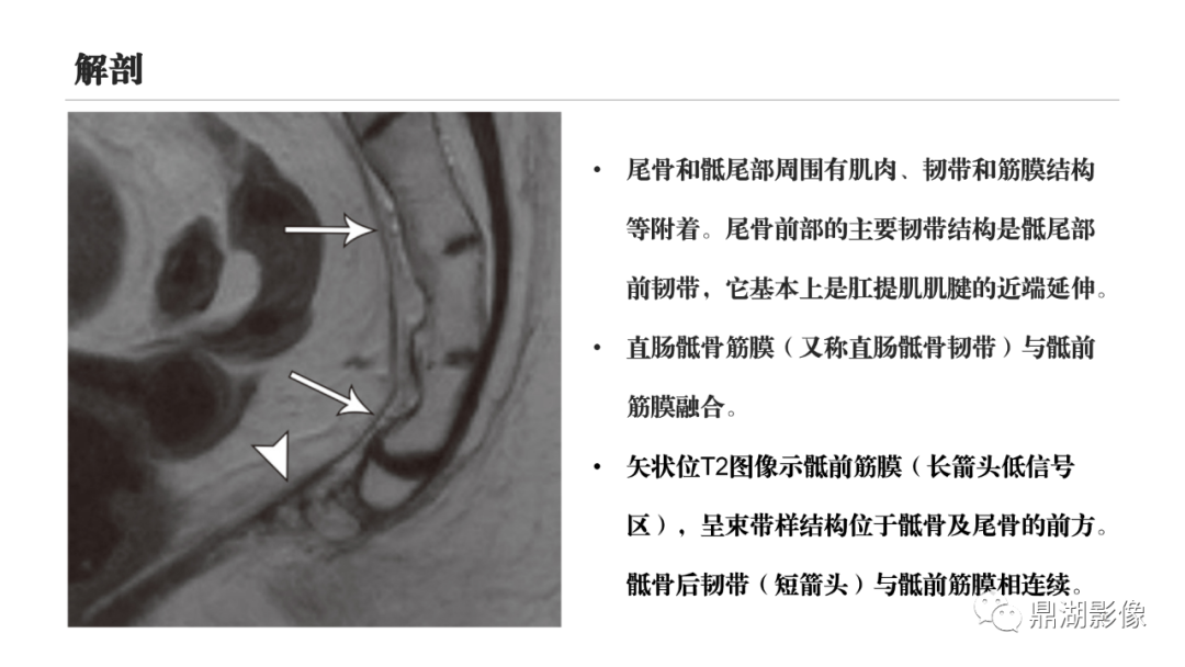 影像PPT - 【PPT】尾骨创伤与尾骨疼痛的影像学表现-12