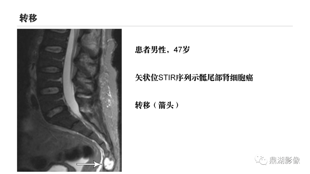 影像PPT - 【PPT】尾骨创伤与尾骨疼痛的影像学表现-29